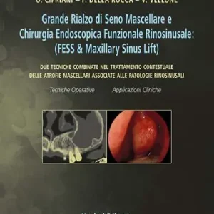 Vendita Finale Grande rialzo di seno mascellare e chirurgia endoscopica funzionale rinosinusale. Due tecniche combinate nel trattamento contestuale delle atrofie mascellari associate alle patologie rinosinusali