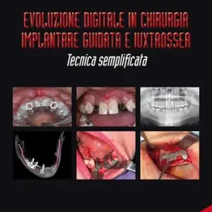 Evoluzione digitale in chirurgia implantare guidata e iuxtaossea. Tecnica semplificata. Ediz. italiana e inglese. Con QR Code Nuova Collezione